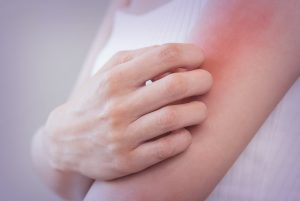 woman scratching her inflamed left upper arm