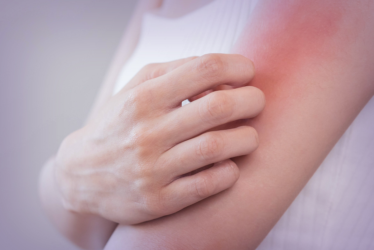 woman scratching her inflamed left upper arm
